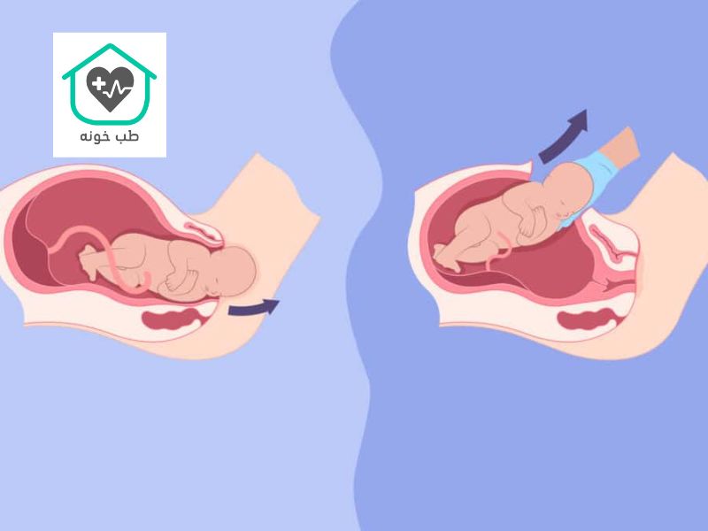 زایمان طبیعی بهتر است یا سزارین