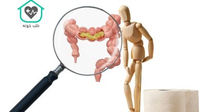 شکل مدفوع در سندروم روده تحریک پذیر