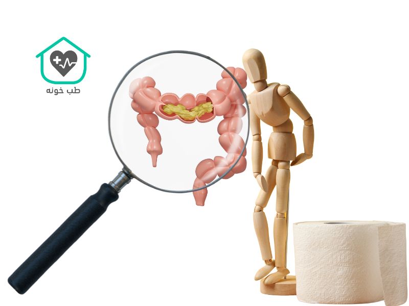 شکل مدفوع در سندروم روده تحریک پذیر