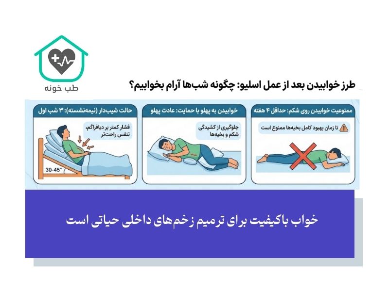 طرز خوابیدن بعد از عمل اسلیو