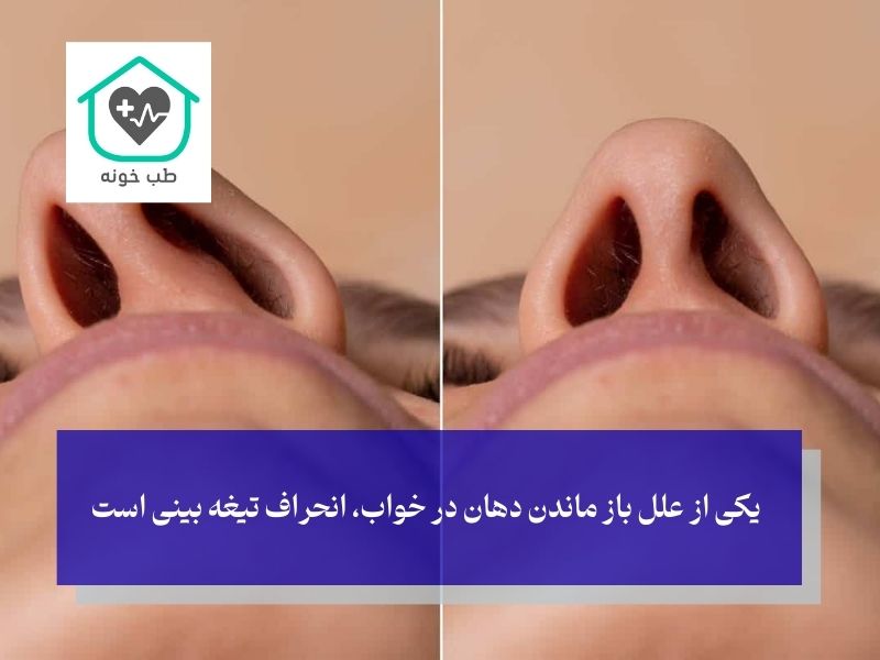 علت باز ماندن دهان در خواب