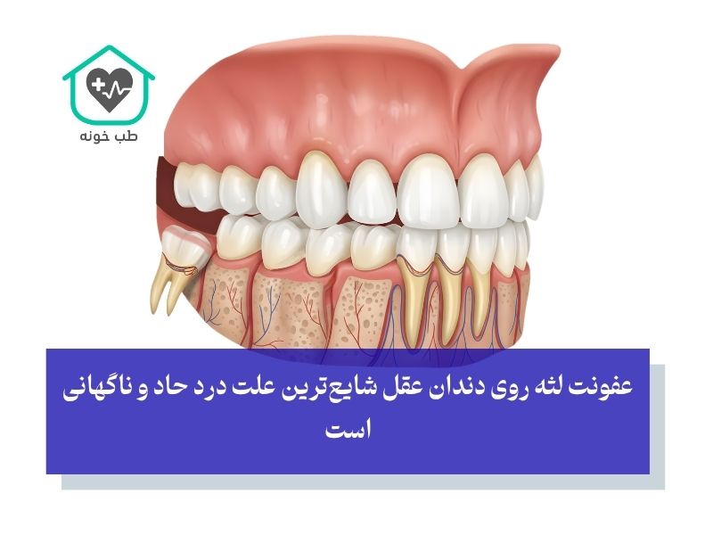 چرا دندان عقل اینقدر دردسرساز است؟ ریشه‌یابی علل درد