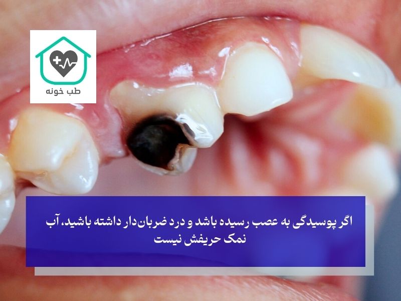 آب نمک برای دندان درد