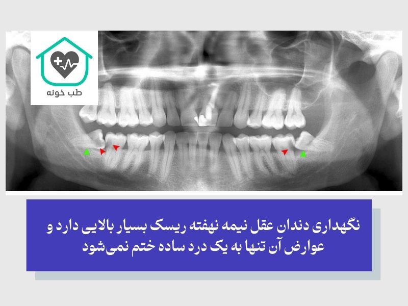 آیا جراحی دندان عقل ضروری است