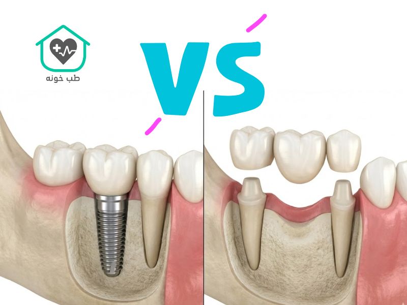 بریج بهتر است یا ایمپلنت