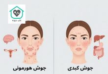تفاوت جوش هورمونی و کبدی