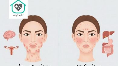 تفاوت جوش هورمونی و کبدی