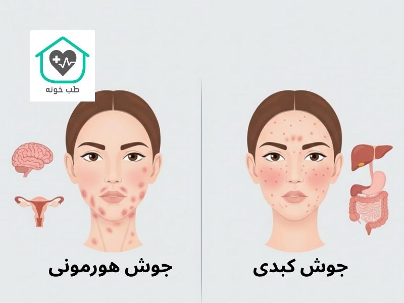 تفاوت جوش هورمونی و کبدی