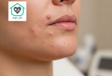 جوش هورمونی صورت