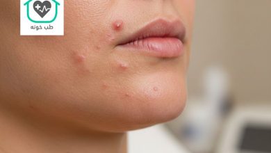 جوش هورمونی صورت