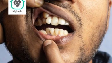 دندان اضافه