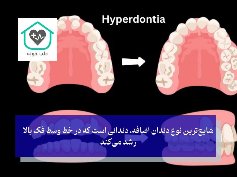 دندان اضافه بر اساس محل رویش