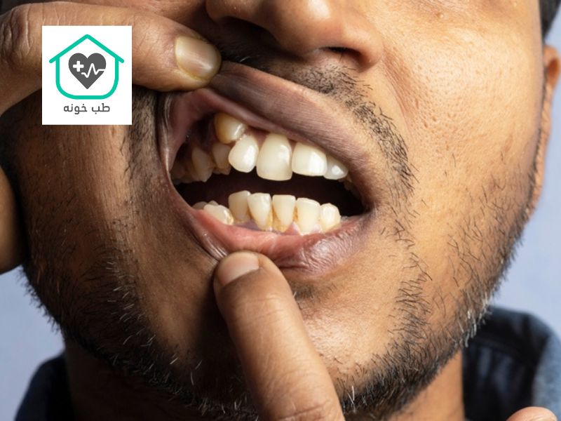 دندان اضافه