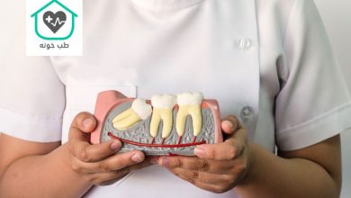 دندان عقل نیمه نهفته