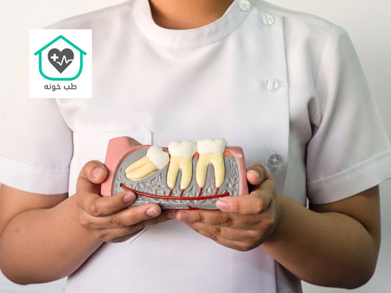 دندان عقل نیمه نهفته