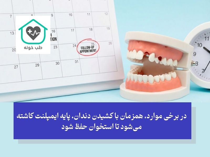 زمان طلایی؛ چه مدت بعد از کشیدن دندان باید اقدام کرد؟