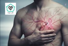 سرطان سینه در مردان