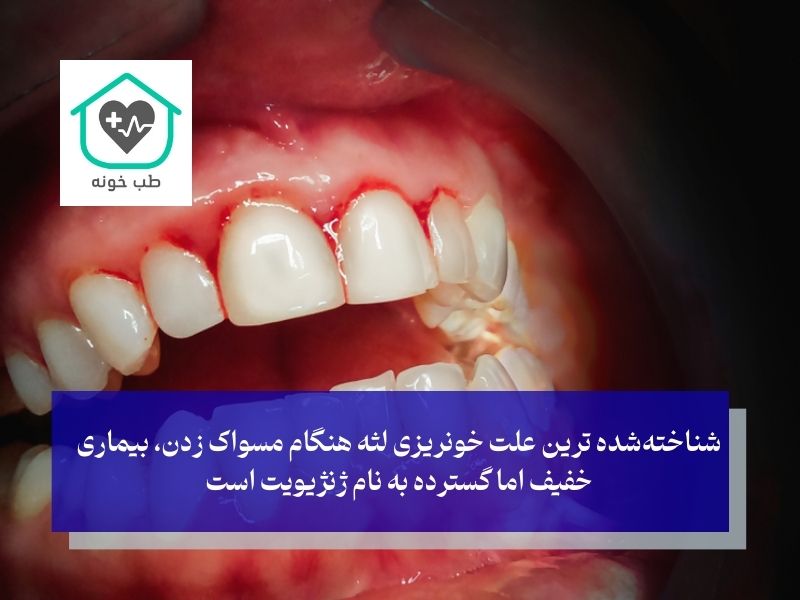 شایع‌ترین علت خونریزی لثه هنگام مسواک زدن