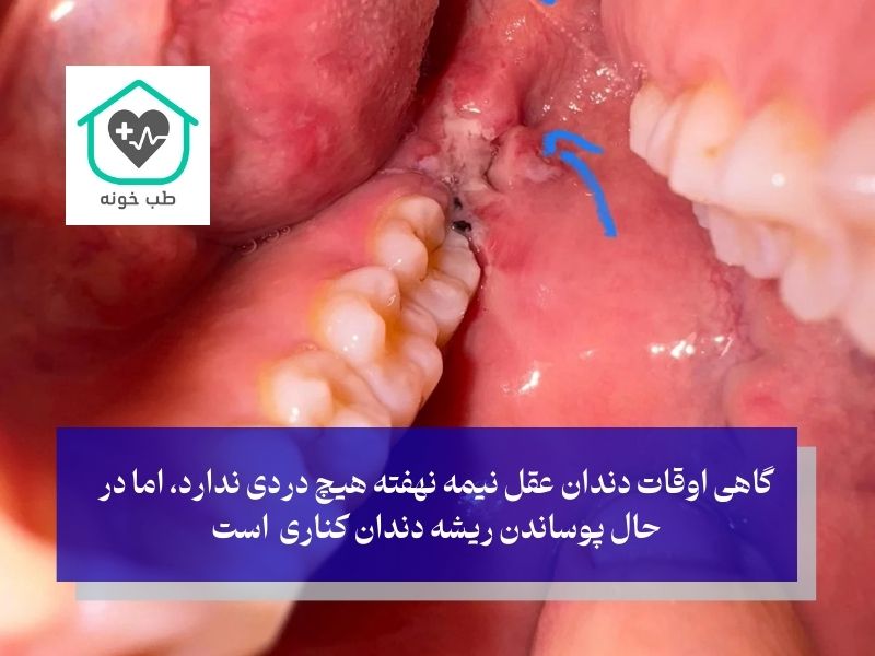 علائم دندان عقل نیمه نهفته چیست