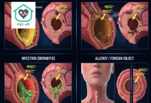 علت خس خس سینه