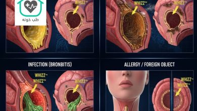 علت خس خس سینه