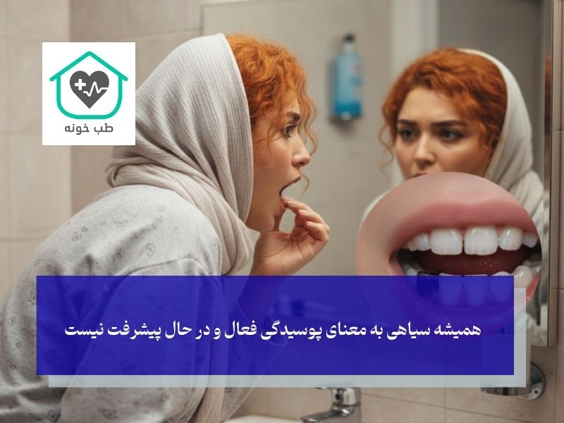 علت سیاه شدن دندان های عقب و سیاه شدن دندان آسیاب