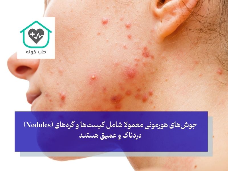 عکس جوش ‌های هورمونی