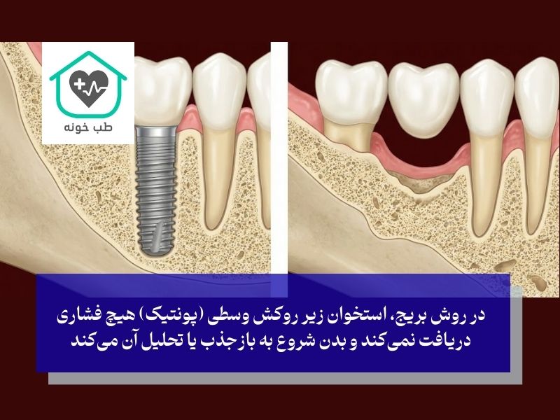 فاجعه خاموش؛ تحلیل استخوان فک و پیری زودرس صورت