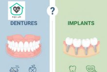 فرق اوردنچر با ایمپلنت