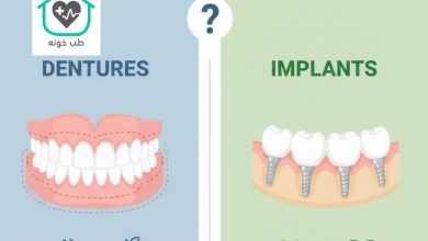 فرق اوردنچر با ایمپلنت