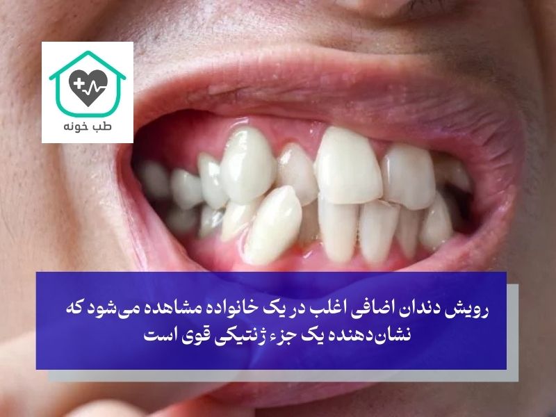 معمای رویش دندان اضافه