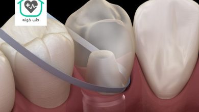 نخ دندان مخصوص ایمپلنت