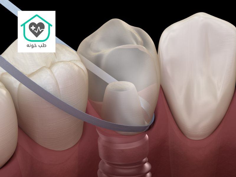 نخ دندان مخصوص ایمپلنت