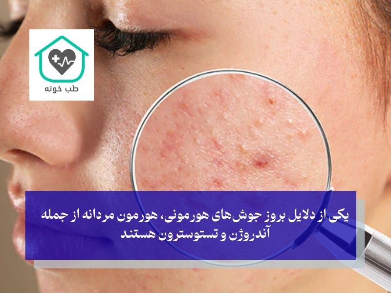 نقش تستوسترون و آندروژن‌ها در بروز جوش