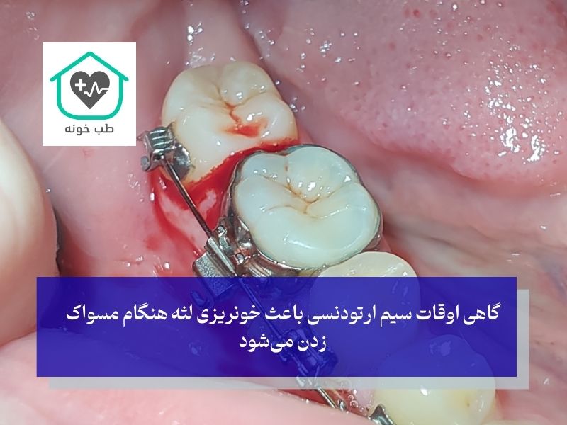 وسایل دندانپزشکی نامناسب علت خونریزی لثه هنگام مسواک زدن