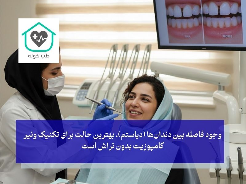 چه کسانی کاندیدای مناسب برای کامپوزیت بدون تراش هستند