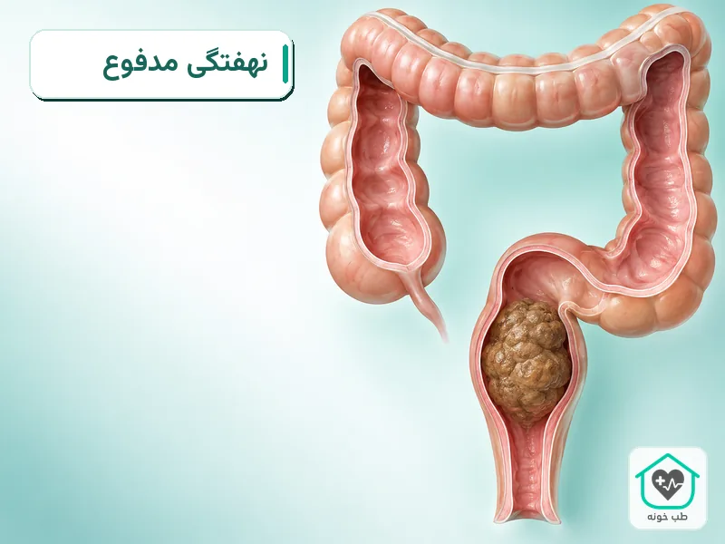 تصویر آموزشی تجمع مدفوع سفت در راست‌روده در نهفتگی مدفوع