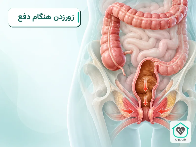 نمای آموزشی فشار هنگام دفع و ارتباط زورزدن با تحریک ناحیه راست‌روده