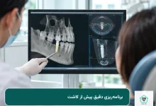 ایمپلنت دندان جلو و برنامهریزی کاشت ایمپلنت