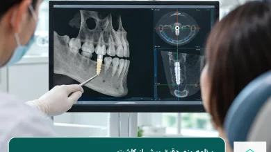 ایمپلنت دندان جلو و برنامه‌ریزی کاشت ایمپلنت