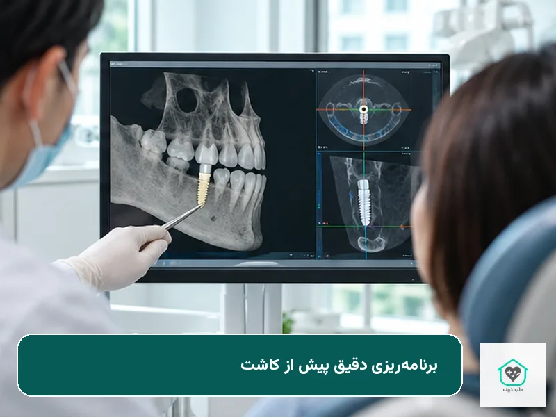 ایمپلنت دندان جلو و برنامهریزی کاشت ایمپلنت