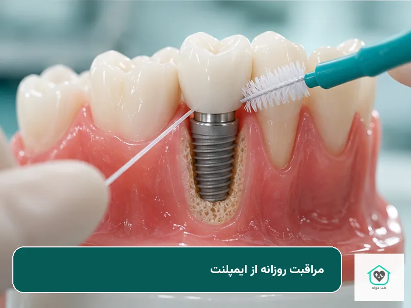تمیز کردن اطراف ایمپلنت دندان