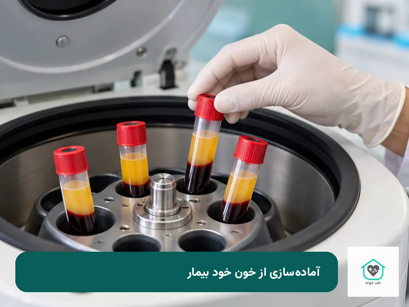 آمادهسازی PRF و PRP از خون خود بیمار